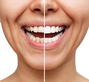 Side by side of cosmetic improvements (Which Cosmetic Dental Service is Right for Me?