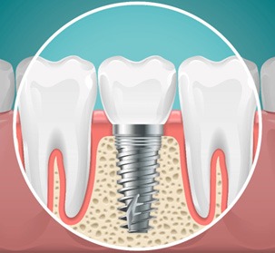 An illustration of a placed dental implant